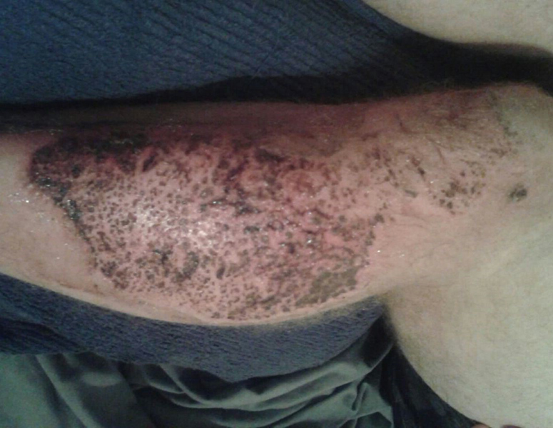 wound Support