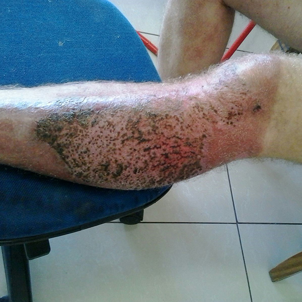 wound Support