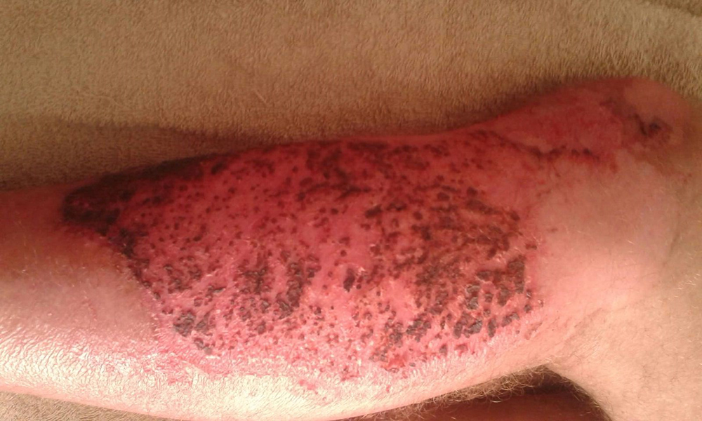 wound Support