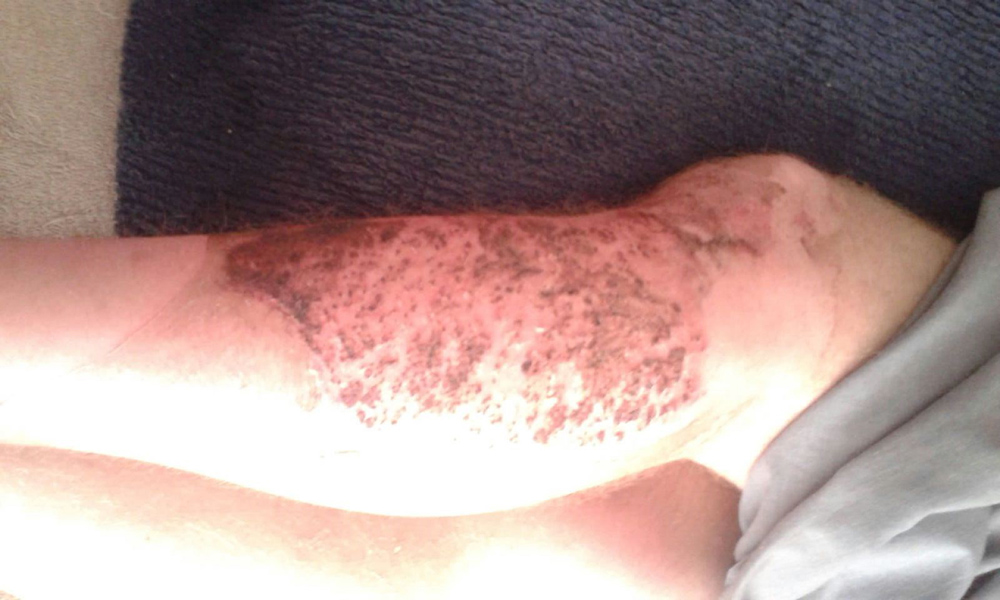 wound Support