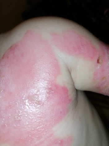 wound Support
