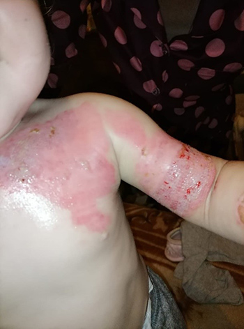 wound Support
