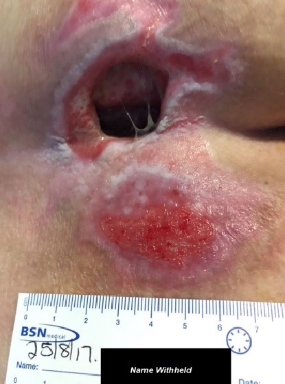 wound Support
