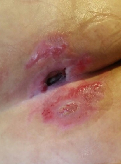 wound Support