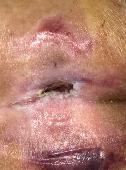 wound Support