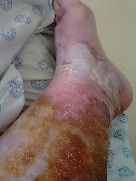 wound Support