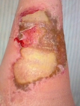 wound Support