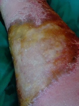 wound Support