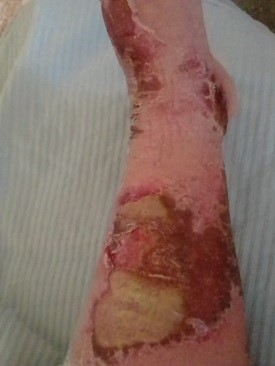 wound Support