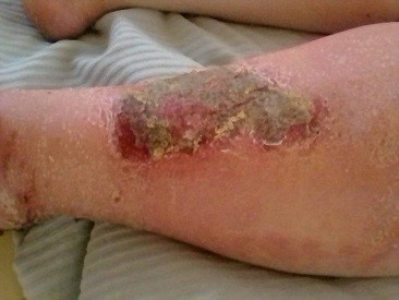 wound Support