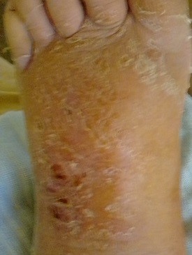 wound Support