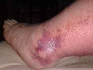 wound Support