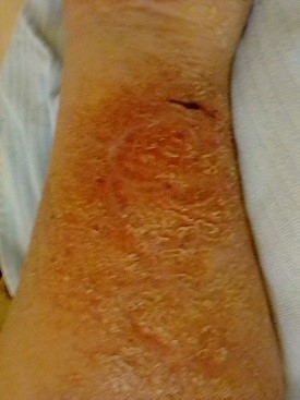 wound Support