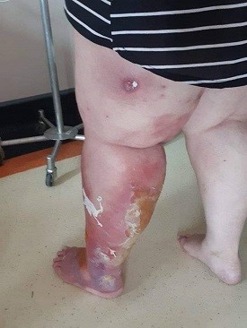 wound Support