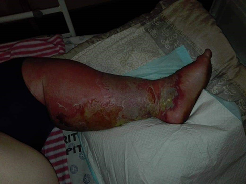 wound Support