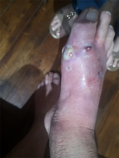 wound Support