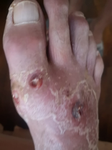 wound Support