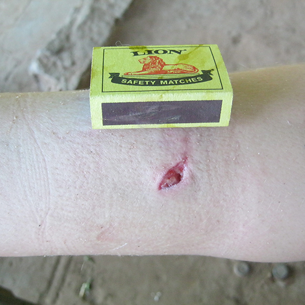 wound Support