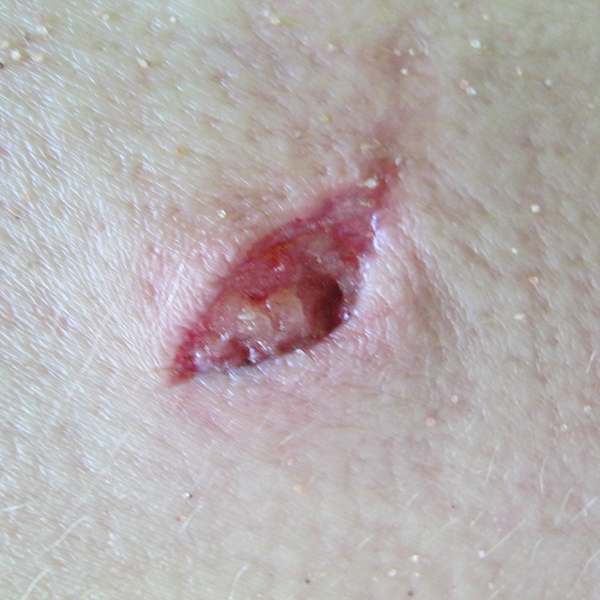 wound Support