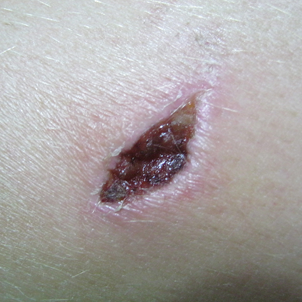 wound Support
