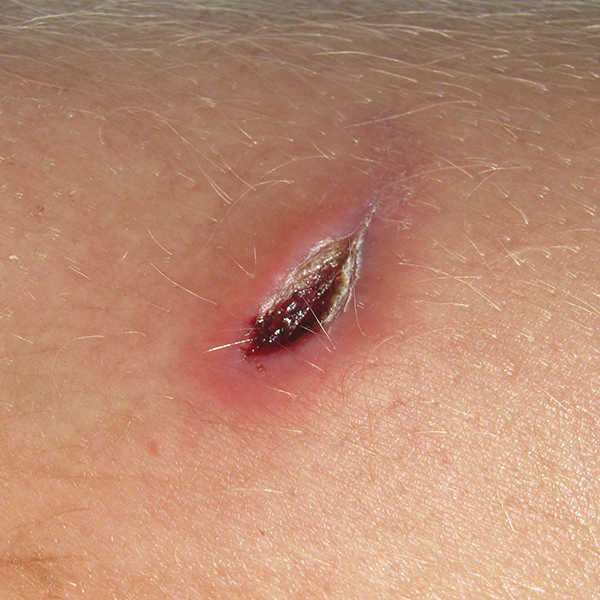 wound Support