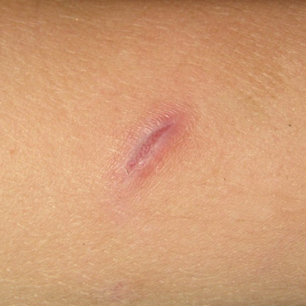wound Support
