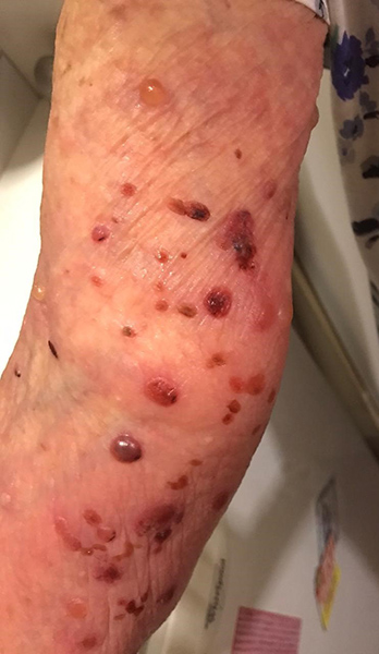 wound Support