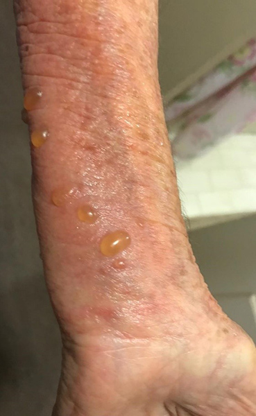 wound Support