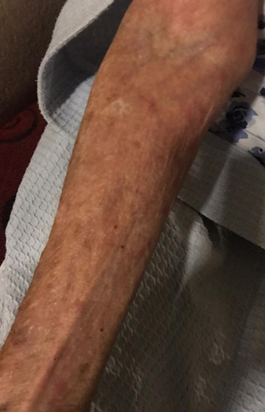 wound Support